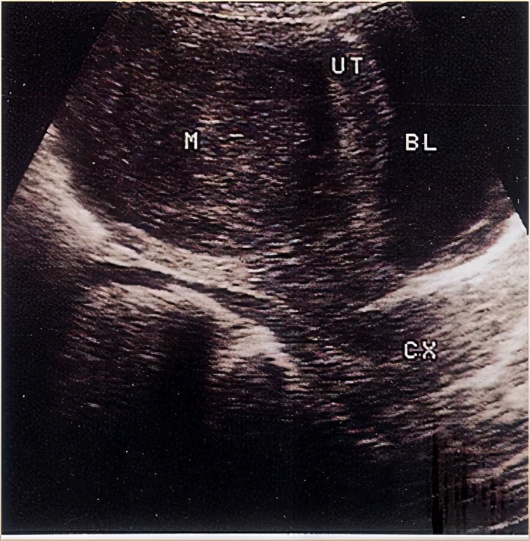 子宫肌瘤切不切有什么影响,切子宫肌瘤和切卵巢哪个伤害大