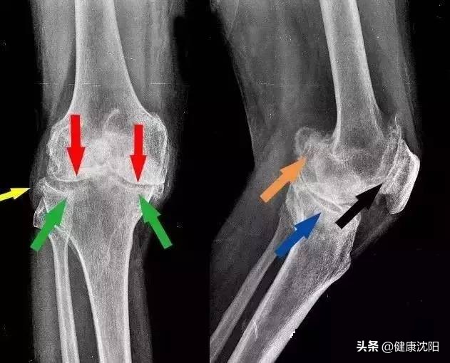 世界关节炎日科普视频,骨刺和关节炎有哪些区别