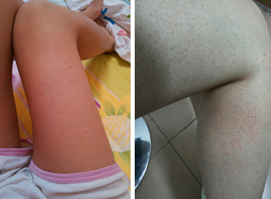 腿上鸡皮肤怎么彻底解决,腿上有鸡皮肤怎么做可以减轻点呢