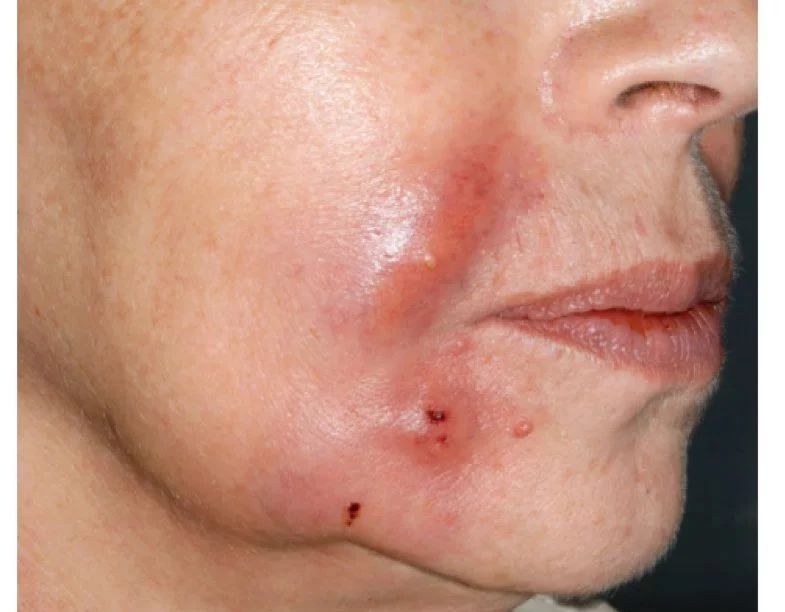 玻尿酸注射下巴的过程视频,注射玻尿酸能维持多长时间