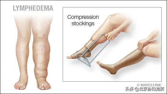 淋巴水肿哪个医院治疗最好,淋巴回流障碍性水肿怎么治疗
