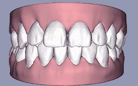 戴一个牙套会掉吗,戴个牙套对嘴唇有变化吗