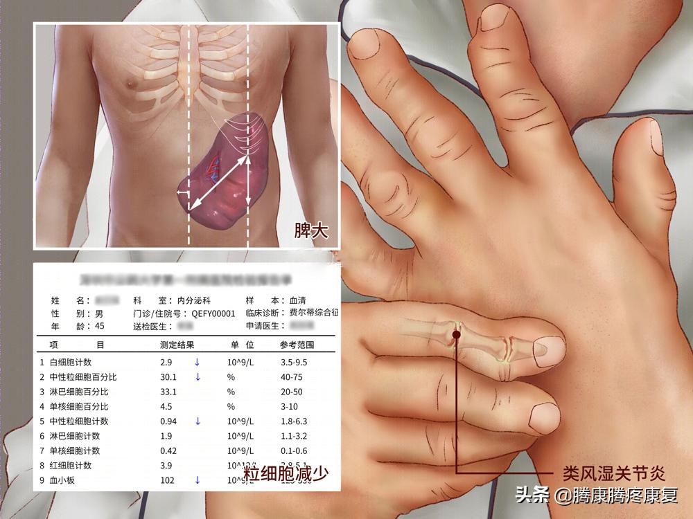 类风湿关节炎病因与发病机制,类风湿关节炎的病因与发病机制