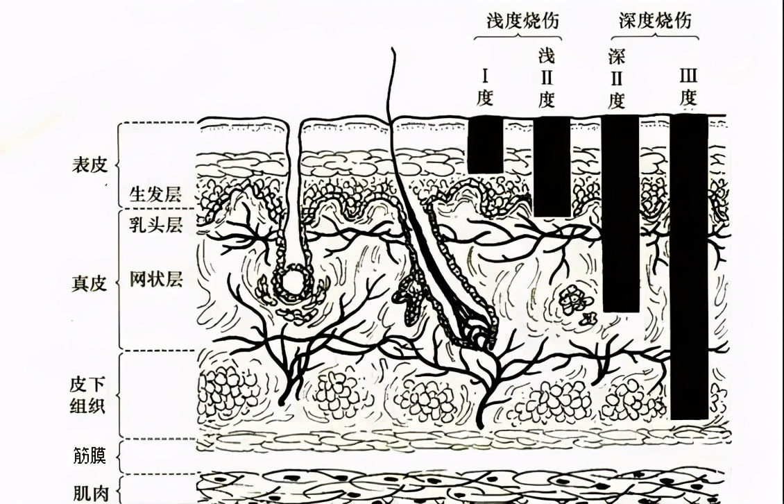 被火烫伤疤痕修复最好的方法,烧烫伤疤痕治疗的方法都有哪些