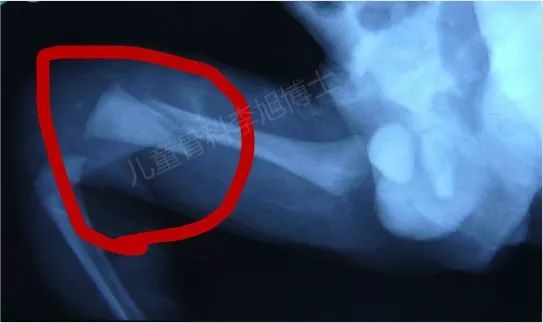 婴儿股骨骨折会有后遗症吗,六个月婴儿右股骨骨折
