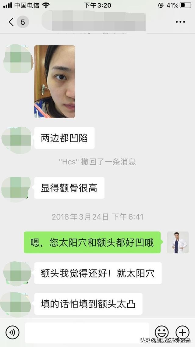 自体脂肪胶填充太阳穴泪沟法令纹,自体脂肪太阳穴填得太饱满了