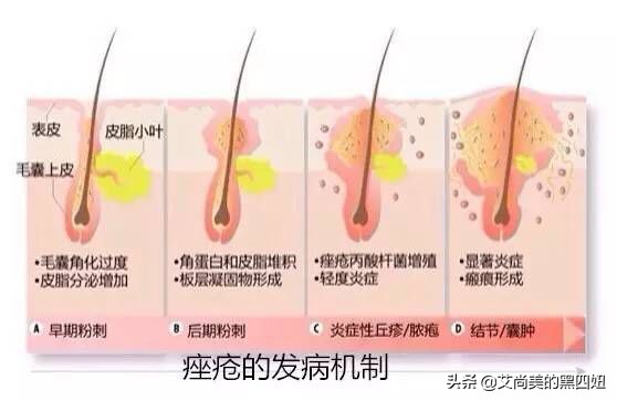 怎么预防和治疗痘,别再为痘痘烦恼祛痘小窍门送给你