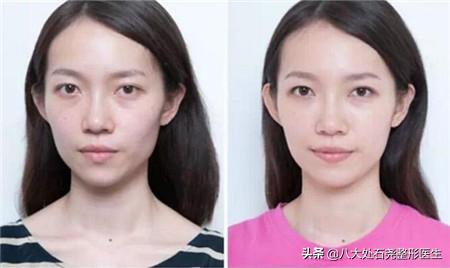 明星太阳穴凹陷怎么解决,太阳穴填充的明星