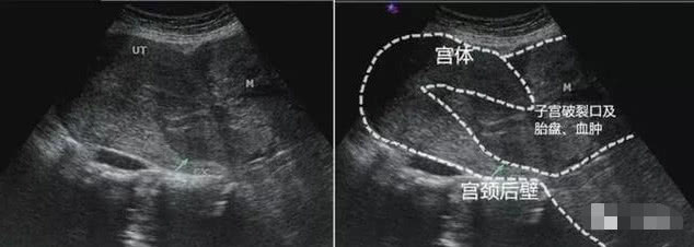 孕妇谎称摔倒,肚子痛医生通过B超发现一个残忍可怕的事实