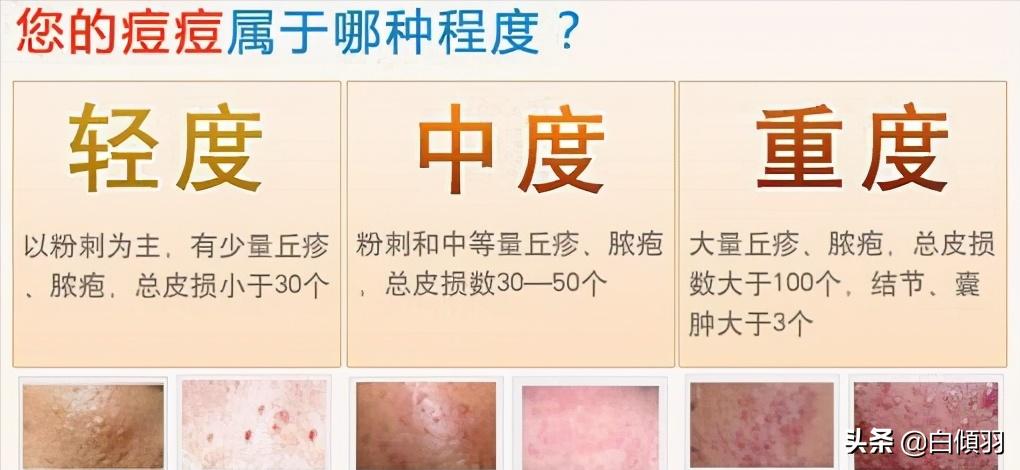 红肿痘痘不疼了但是还是有包,红肿痘痘摸着软软的一直不冒白头