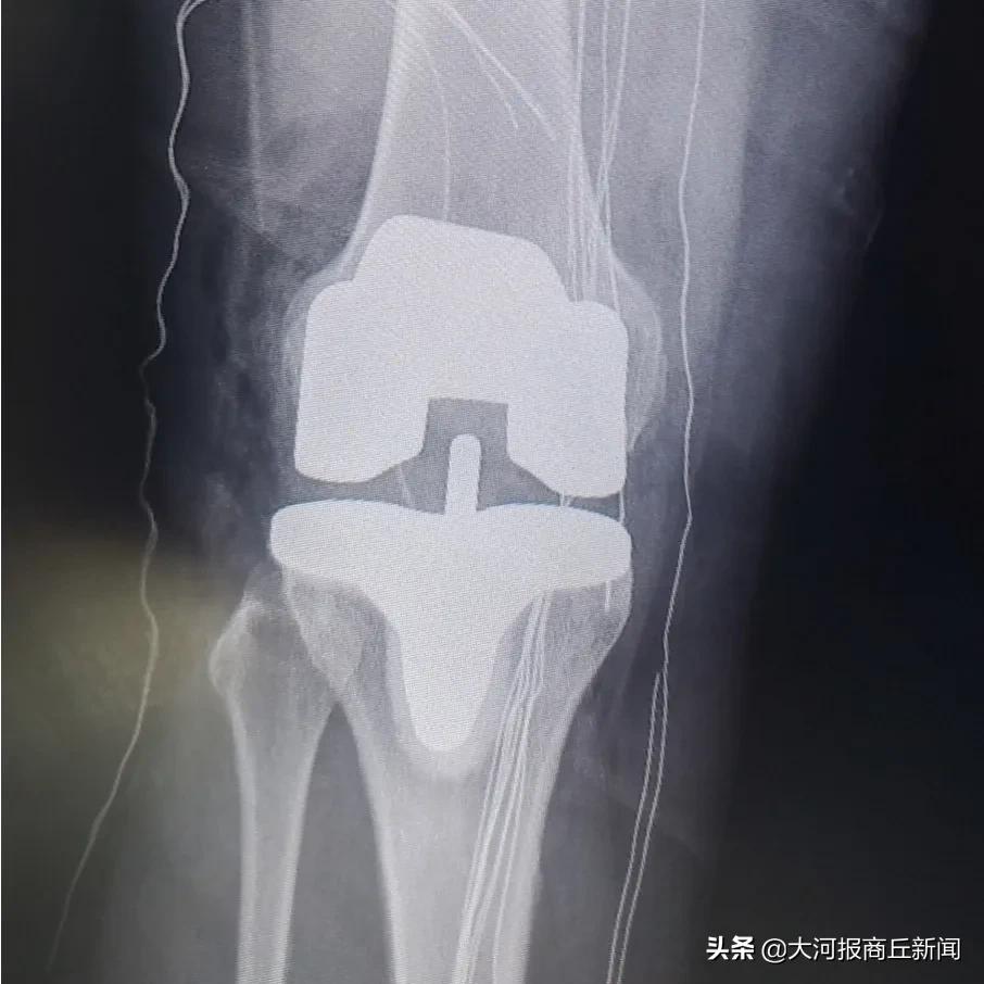重塑健康!3小时4台关节置换圆满完成,柘城中医院再创新速度