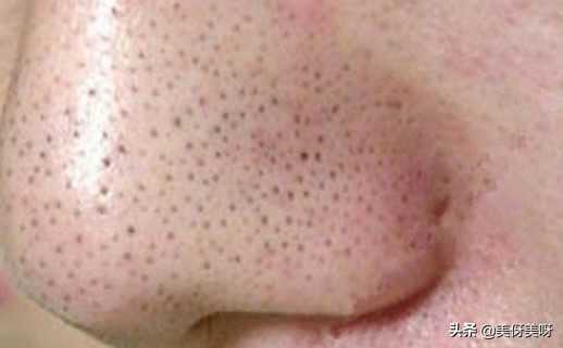 人为什么会长黑头求解：黑头白头的成因及结构和去除方法