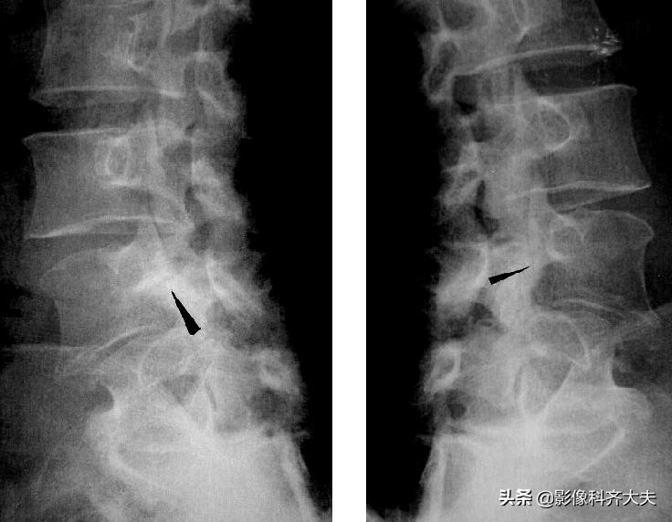 骨折的影像学检查及各自的优势,骨折的影像学愈合标准