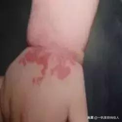 宝宝身上有点小红点,宝宝身上红色胎记但是不凸起