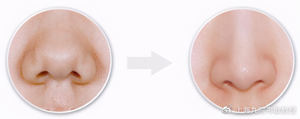 蒜头鼻怎么自己矫正,蒜头鼻塌鼻梁朝天鼻怎么改善