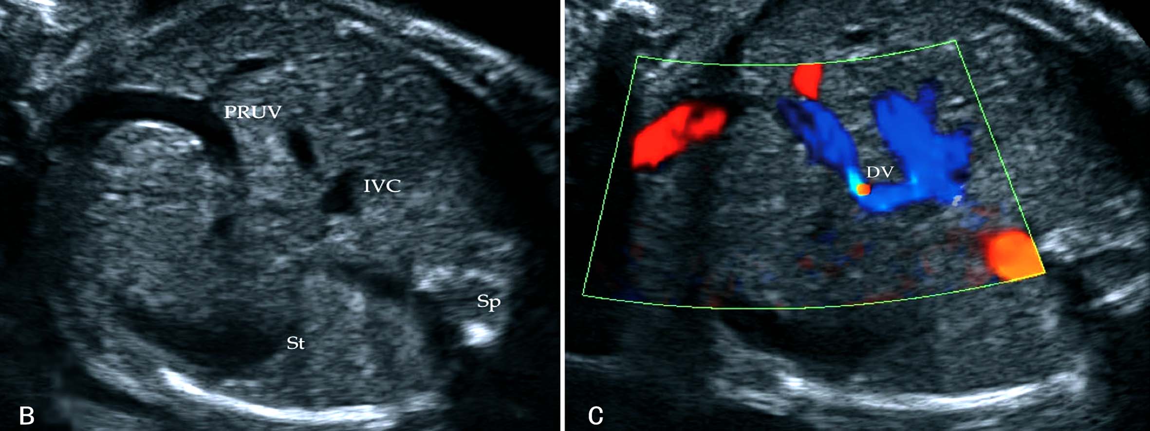 做高清彩超能看出脐带扭转吗,脐带超声异常