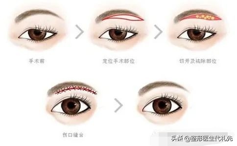 提眉最多一生能做几次提眉,提眉手术怎么操作