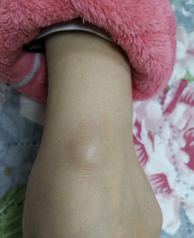 腱鞘囊肿中医神奇治疗方法,腱鞘囊肿针灸治疗