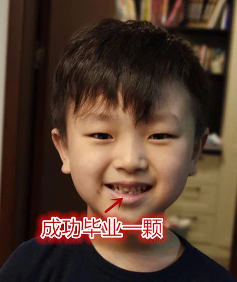 小孩口腔最里面有双排牙,孩子嘴里出了好多牙