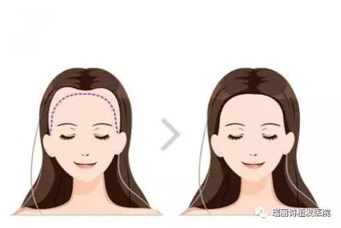 自体毛囊植发怎么植,自体毛发植发价格