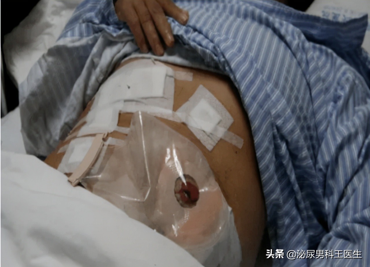 一个人没有直肠怎么办,一个人没有大肠怎么生活