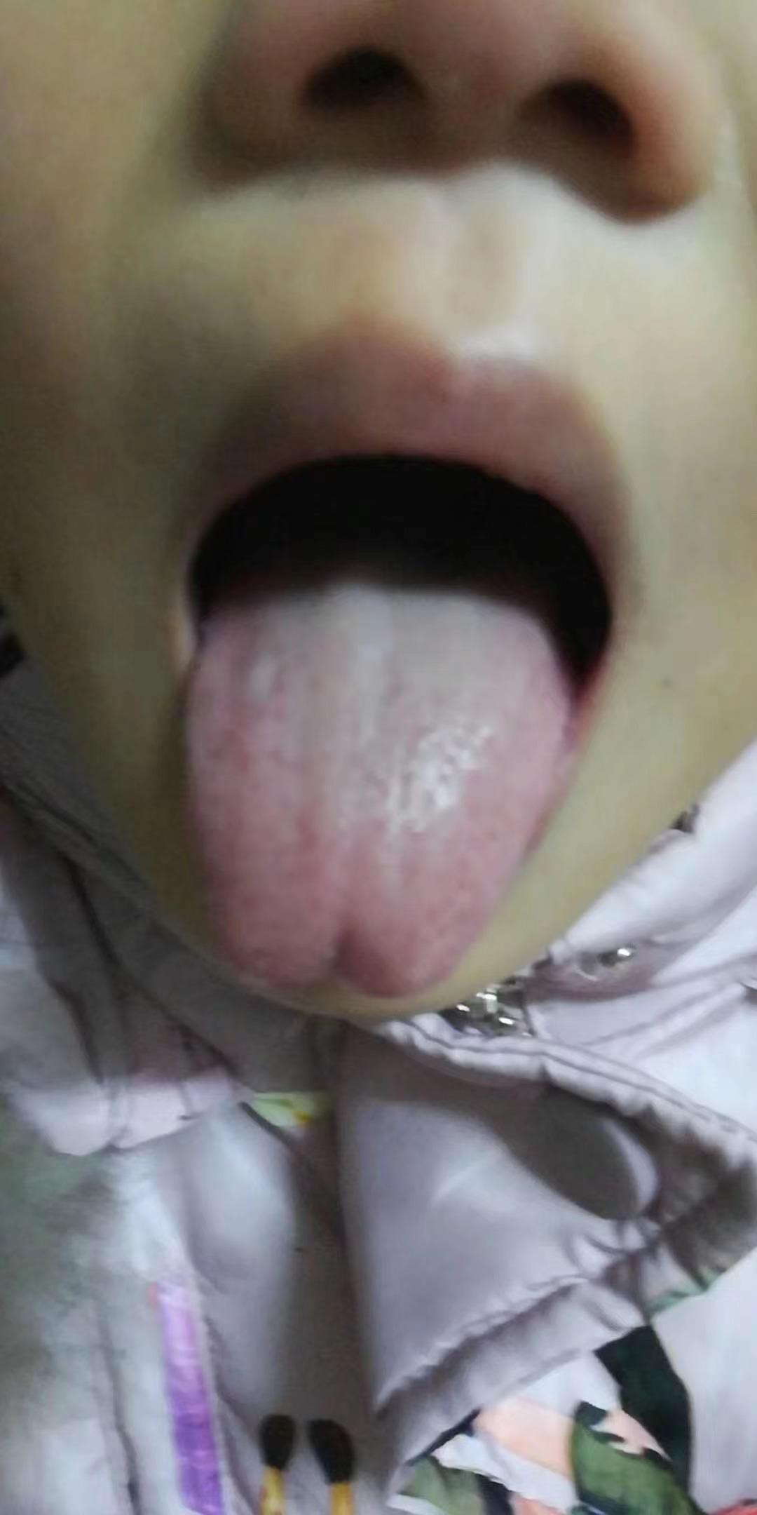 肠系膜淋巴结炎是哪里腹痛,肠系膜淋巴结炎腹痛怎么缓解