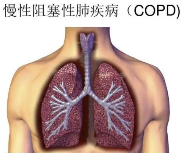 慢阻肺从中医角度的病因,轻度慢阻肺和早期慢阻肺区别