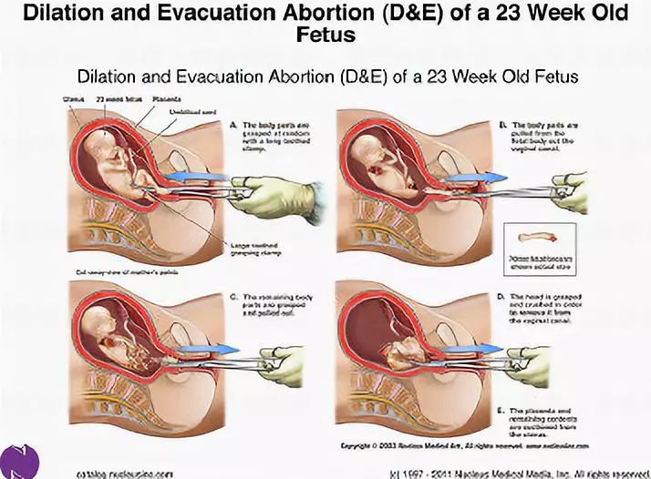 27岁女生做了7次人流,27岁女孩人流