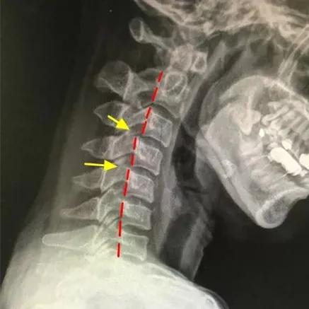 女子坐过山车扭伤颈椎,坐过山车扭伤脖子