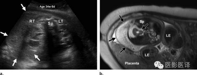 胎儿卵巢囊肿5.6厘米会消失吗,卵巢巨大囊肿与妊娠鉴别