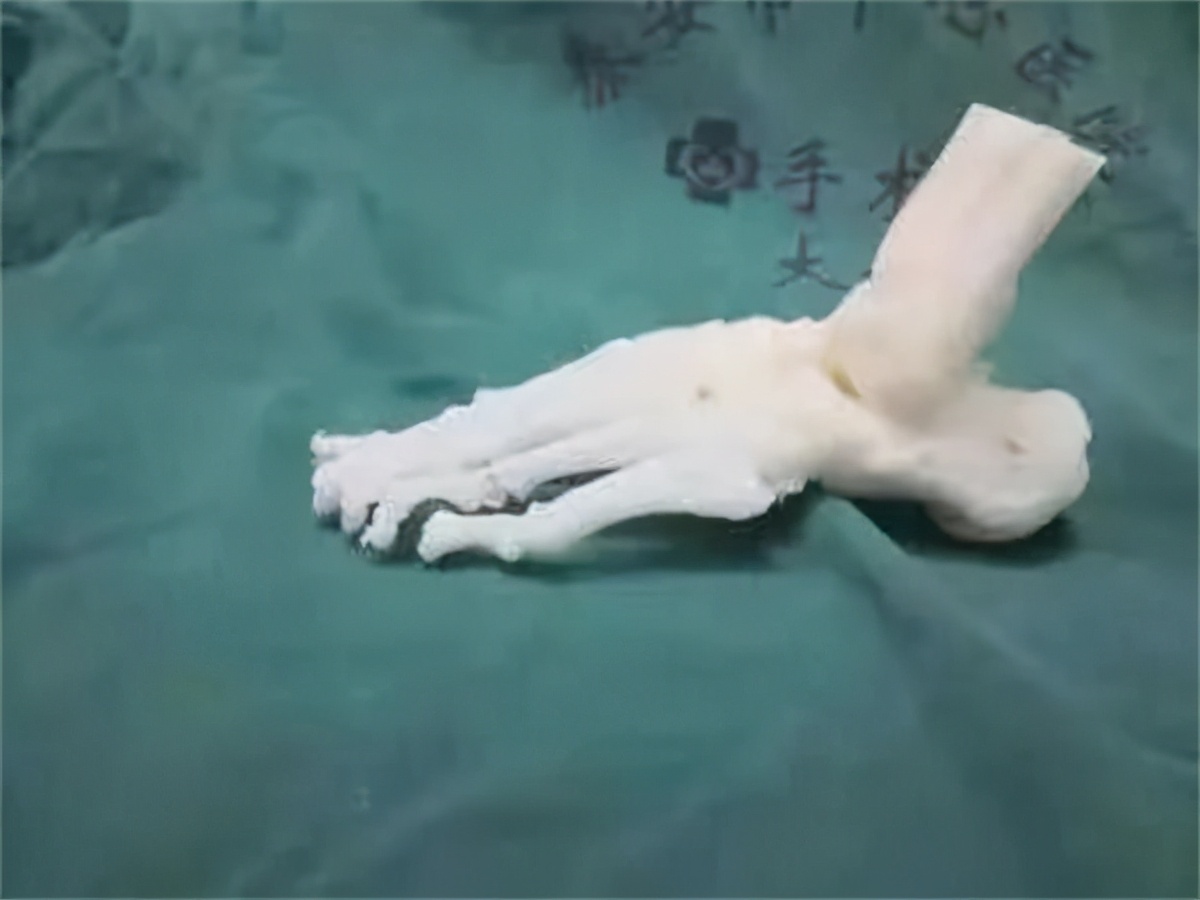 *安泰**市中心医院肢体重建外科运用3D打印技术精准矫治复杂性足踝畸形