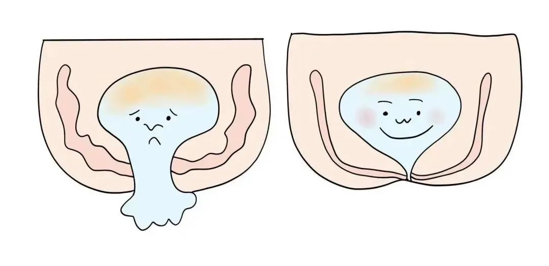 女的咳嗽漏尿是什么原因,咳嗽就漏尿坚持两个动作