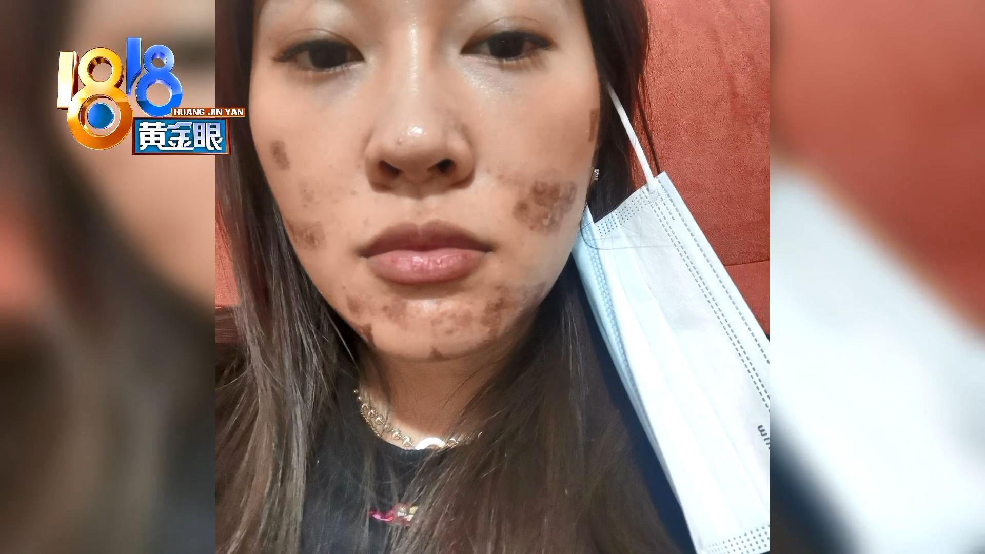 脸上有个黑色痘印一直反复结痂,脸上痘印周围红红的像结痂一样