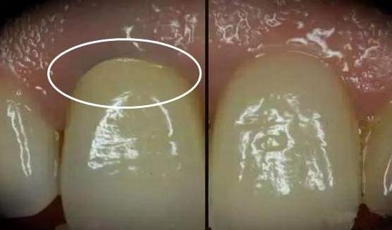 牙龈和牙齿缝黑黑的刷不掉怎么办,牙龈为什么会变黑怎么改善