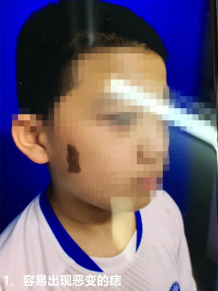 身上有痣到底要不要切除做病理,身上的痣会不会癌变一张图告诉你