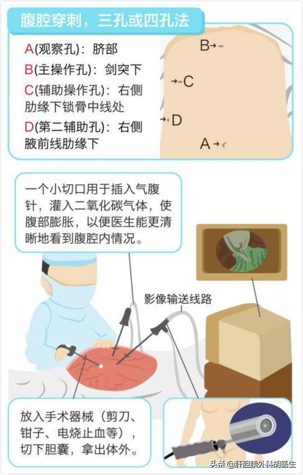 胆囊结石伴随胆囊息肉怎么办,胆囊息肉已经1.9厘米了会不会癌变