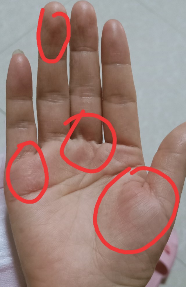 中医慢性荨麻疹自愈经验,慢性荨麻疹中医吃了还是痒