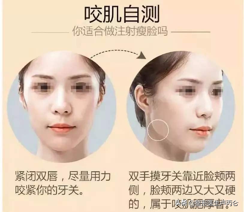 肉毒素咬肌注射多久见效,注射肉毒素咬肌凸起