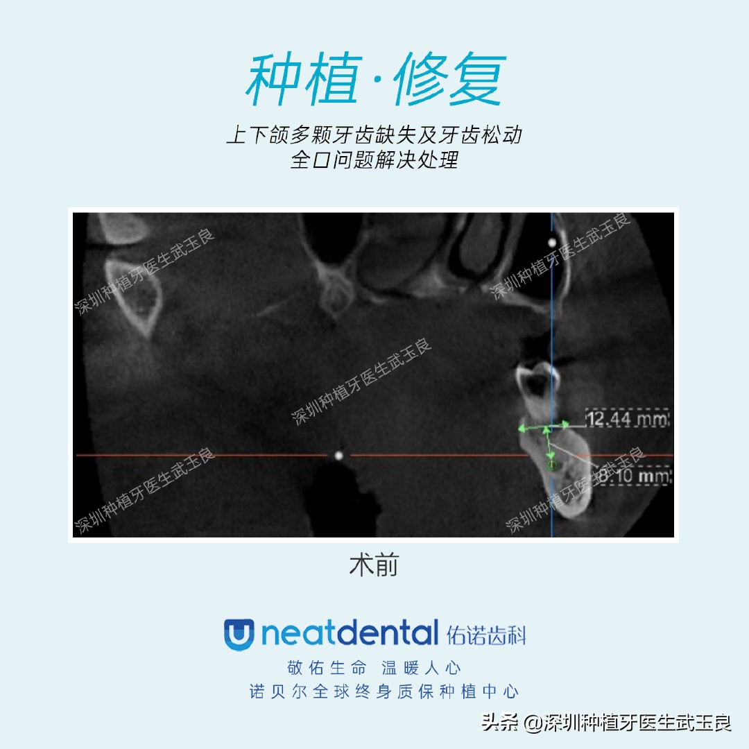 多颗牙齿缺失怎么修复全过程,多颗缺失牙修复案例