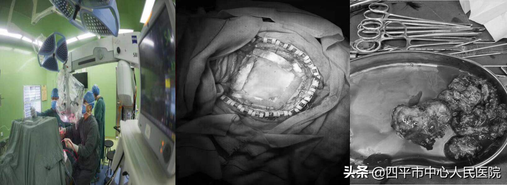 四平市中心医院介入血管外科,颅内胆脂瘤的克星