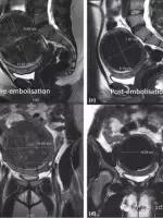 子宫肌瘤腺肌症微创介入科普动画,子宫肌瘤适合微创手术吗