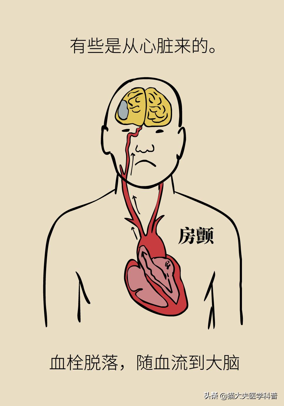 再灌注治疗是什么意思,再灌注治疗