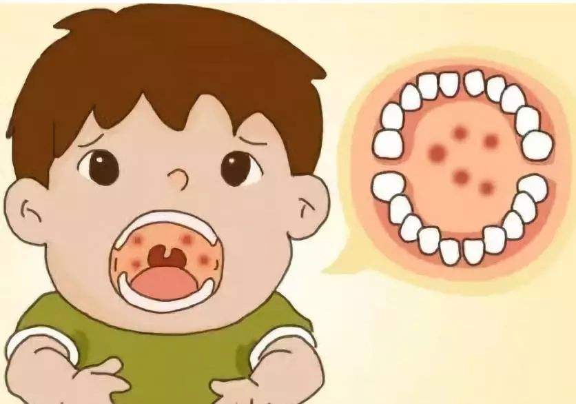 疱疹性咽峡炎吃什么食物较好,疱疹性咽峡炎吃小儿豉翘颗粒