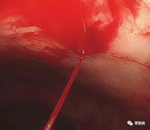 内镜下消化道出血的治疗简报,消化道出血内镜下止血治疗处方