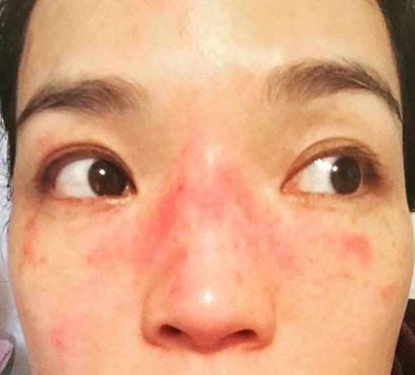 舒淇皮肤过敏,舒淇皮肤过敏化妆