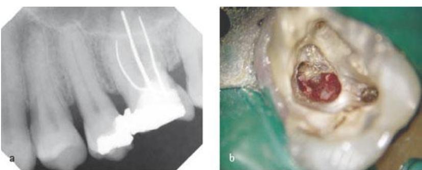 髓底穿孔为什么让拔牙,髓室底穿孔到底用不用拔牙