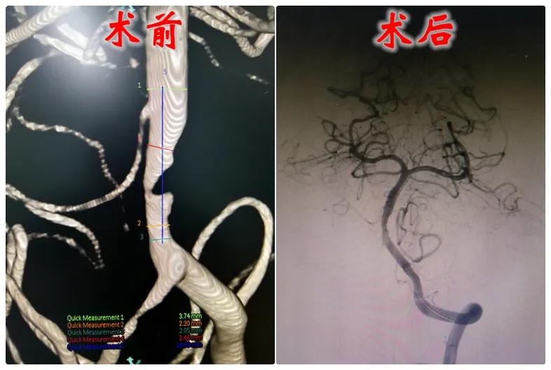 神经介入手术在哪穿刺,血管介入栓塞手术找哪个科