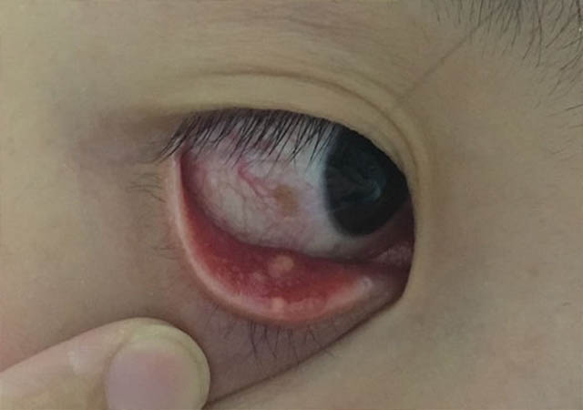 小姐姐脸上长了青春痘,小姐姐担心长斑长痘