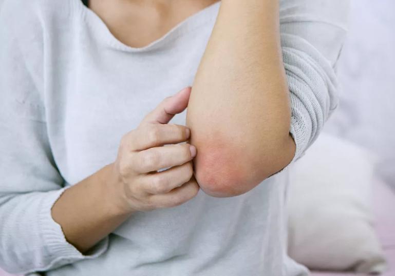 艾滋病患者皮肤会出现什么症状,皮肤瘙痒变硬脱皮是艾滋病症状