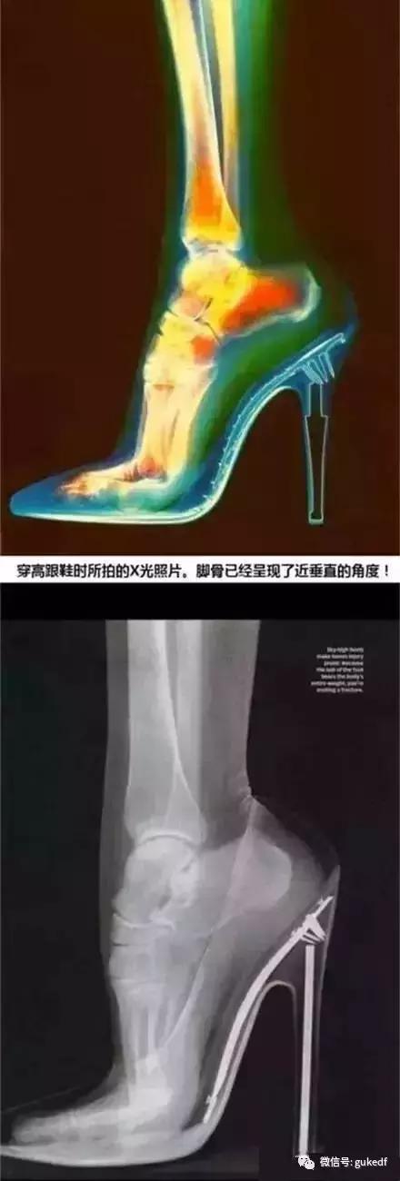 骨科专家支招：这么穿高跟鞋，美丽不伤脚